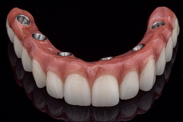 Why Implant Supported Dentures Are A Life Changing Solution For Missing Teeth