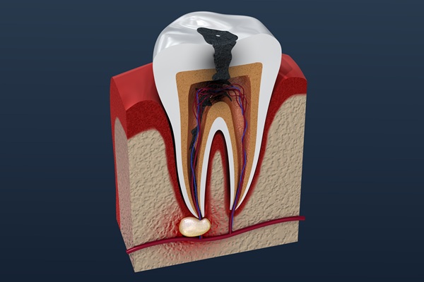 Why Root Canals Are Not As Scary As People Think